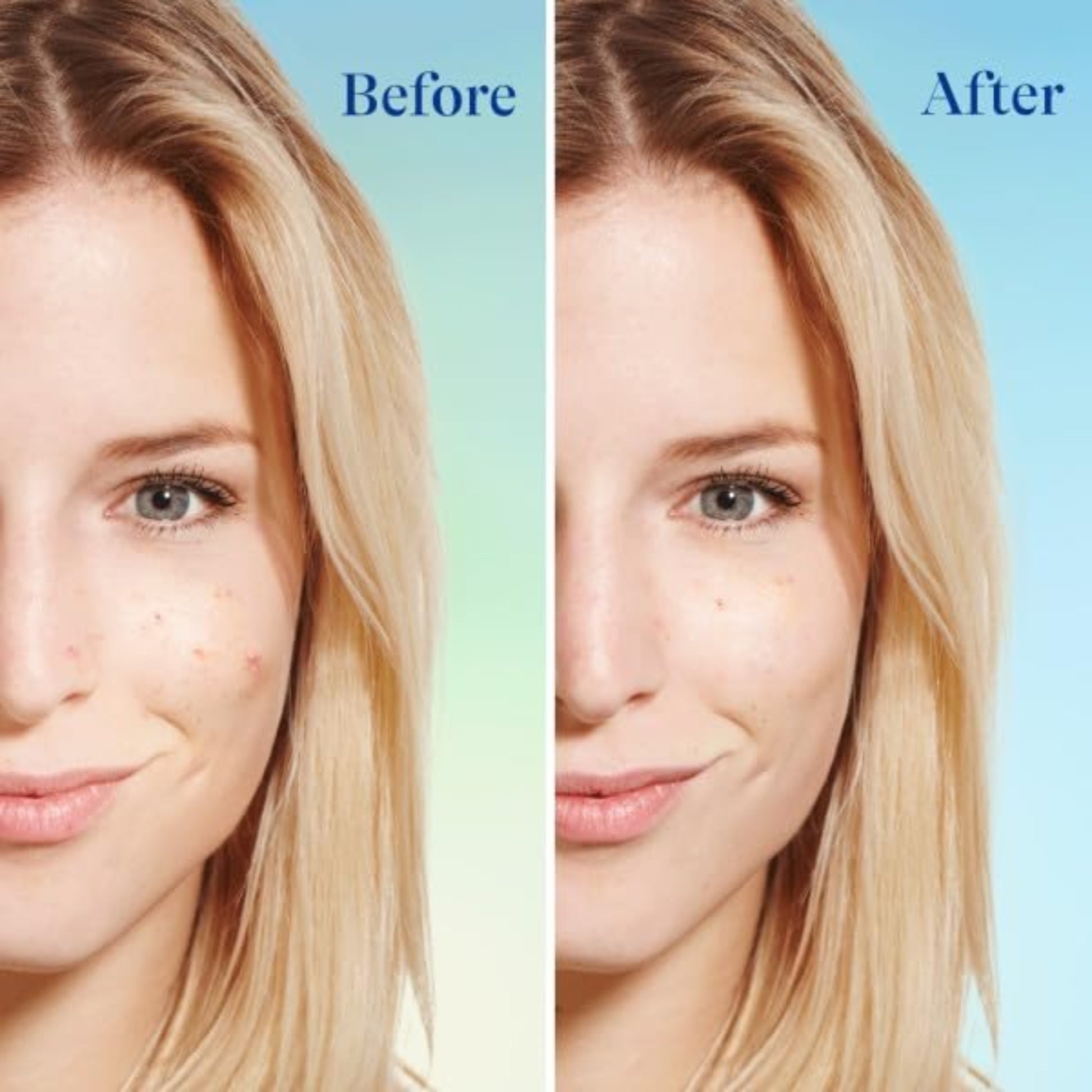 Before and after comparison of a woman's face with visible skin improvement.