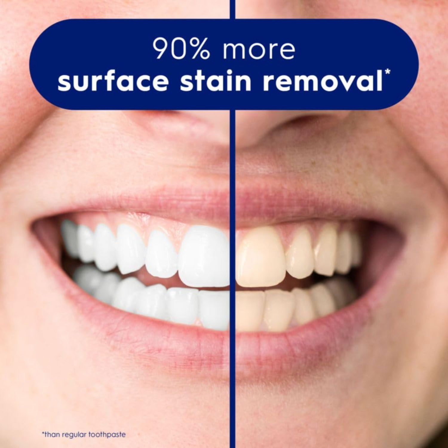 Before and after comparison of teeth with text indicating 90% more surface stain removal.