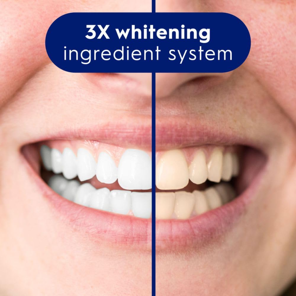 Comparison of teeth with and without a 3X whitening ingredient system.