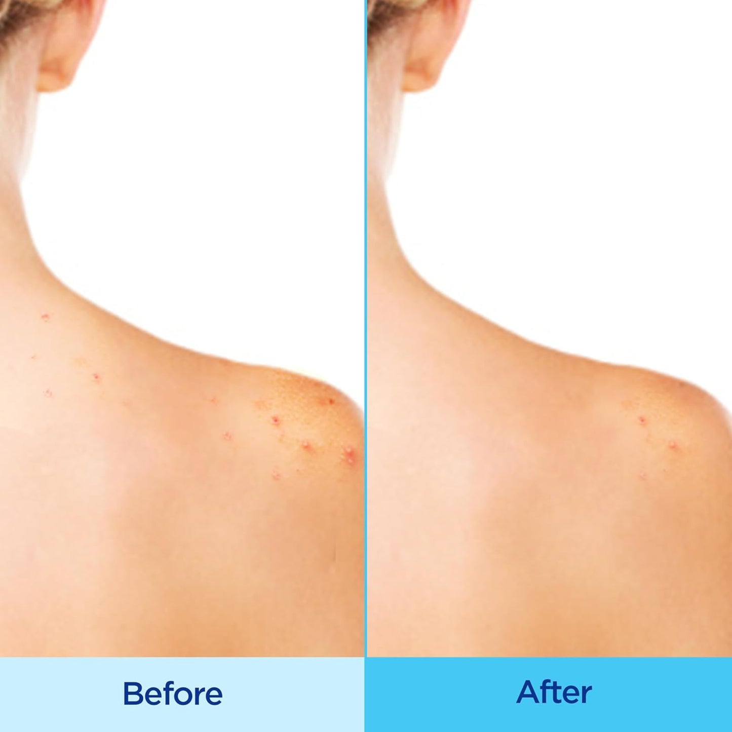 Before and after comparison of skin on a person's neck and shoulders.