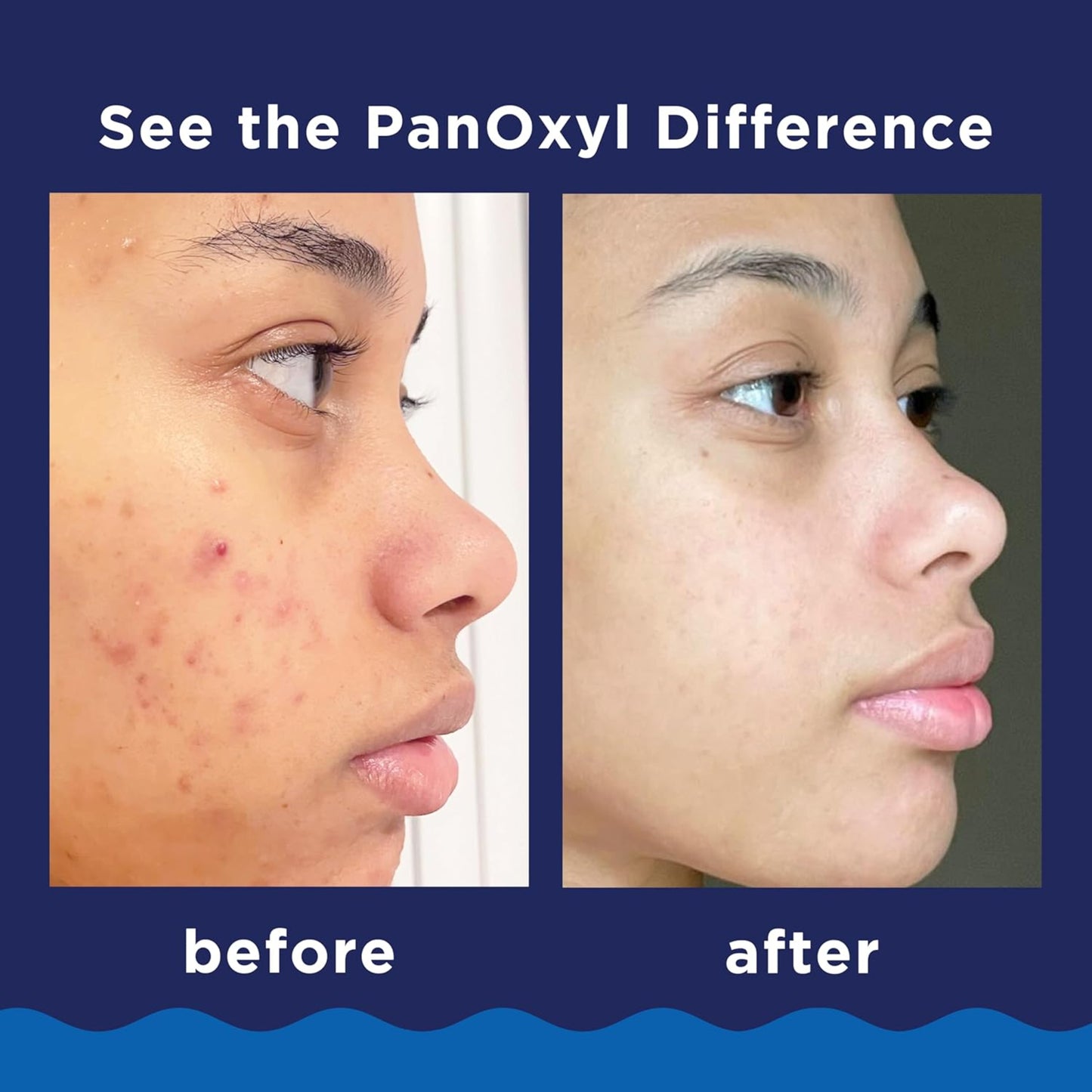 PANOXYL - Acne Antimicrobial Foaming Benzoyl Peroxide Wash 10% -146gr