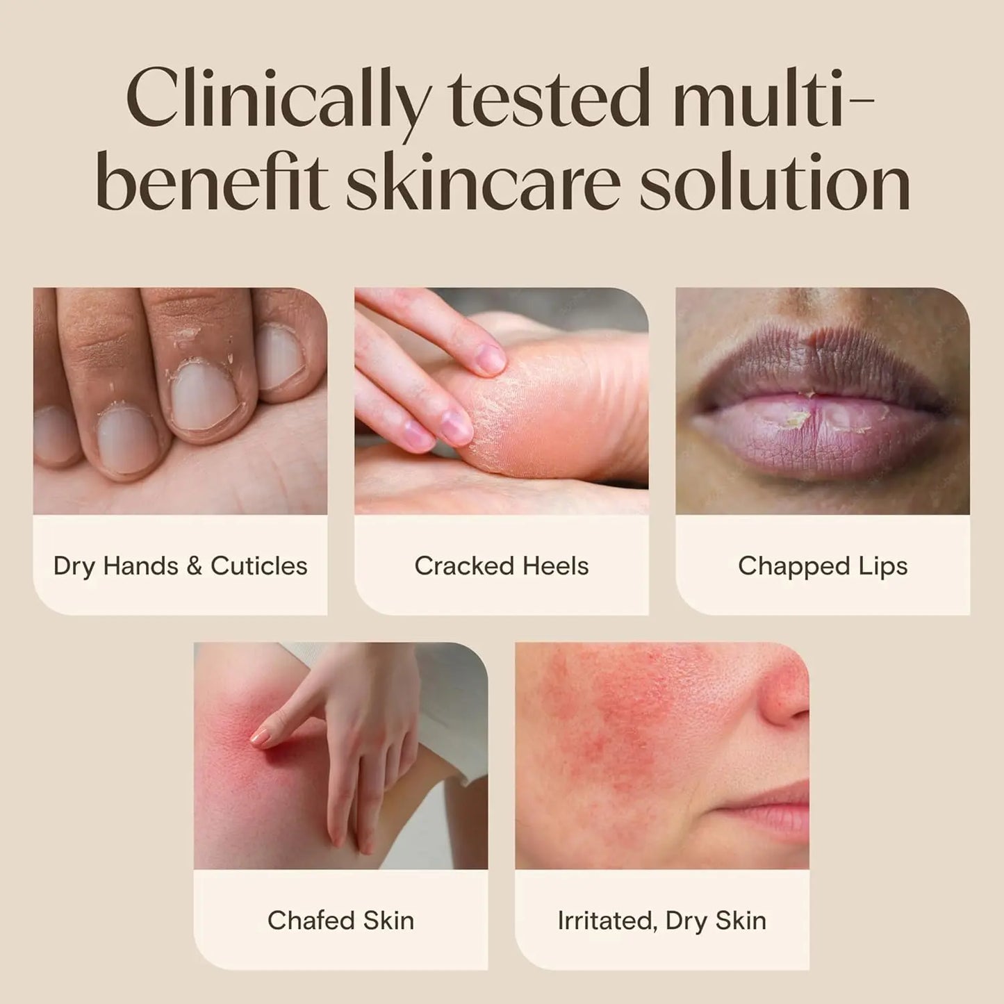Skincare solution for dry hands, cracked heels, chapped lips, chafed skin, and irritated skin.