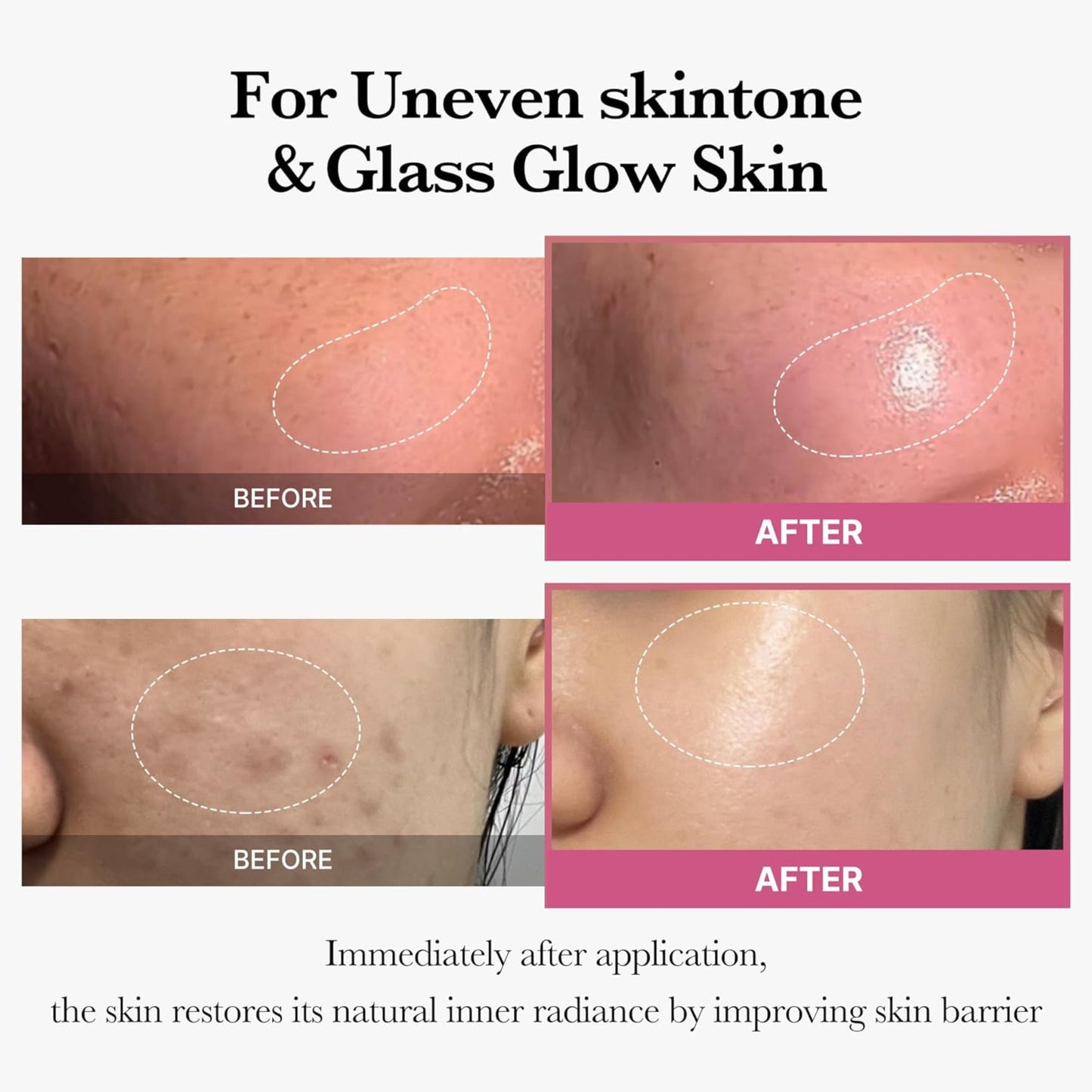 Before and after comparison of skin treatment for uneven skin tone and glass glow skin.