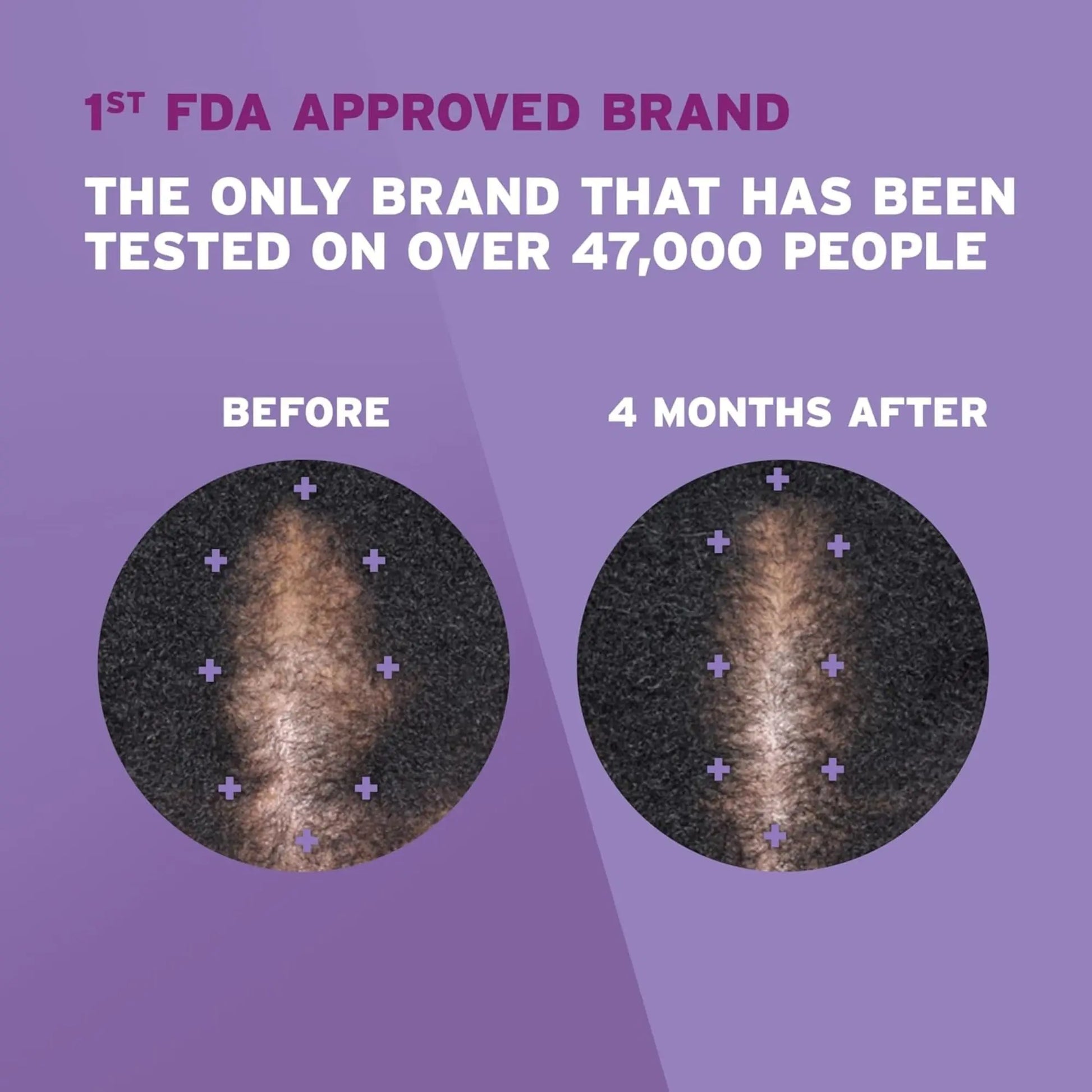 Rogaine WOMEN 5% Minoxidil Foam, Hair Loss 1 Month supply ROGAINE