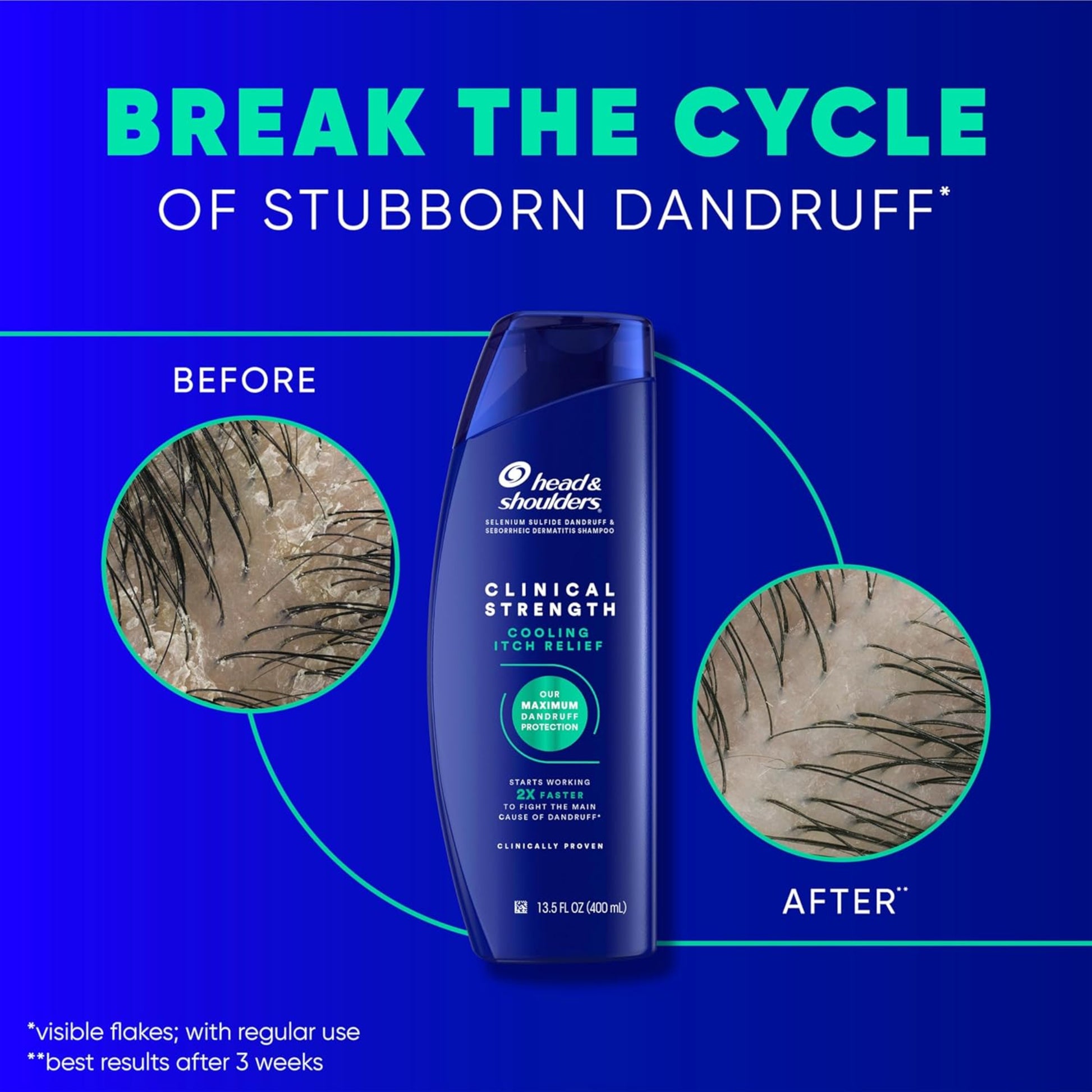 Head & Shoulders shampoo bottle with dandruff before and after images on a blue background