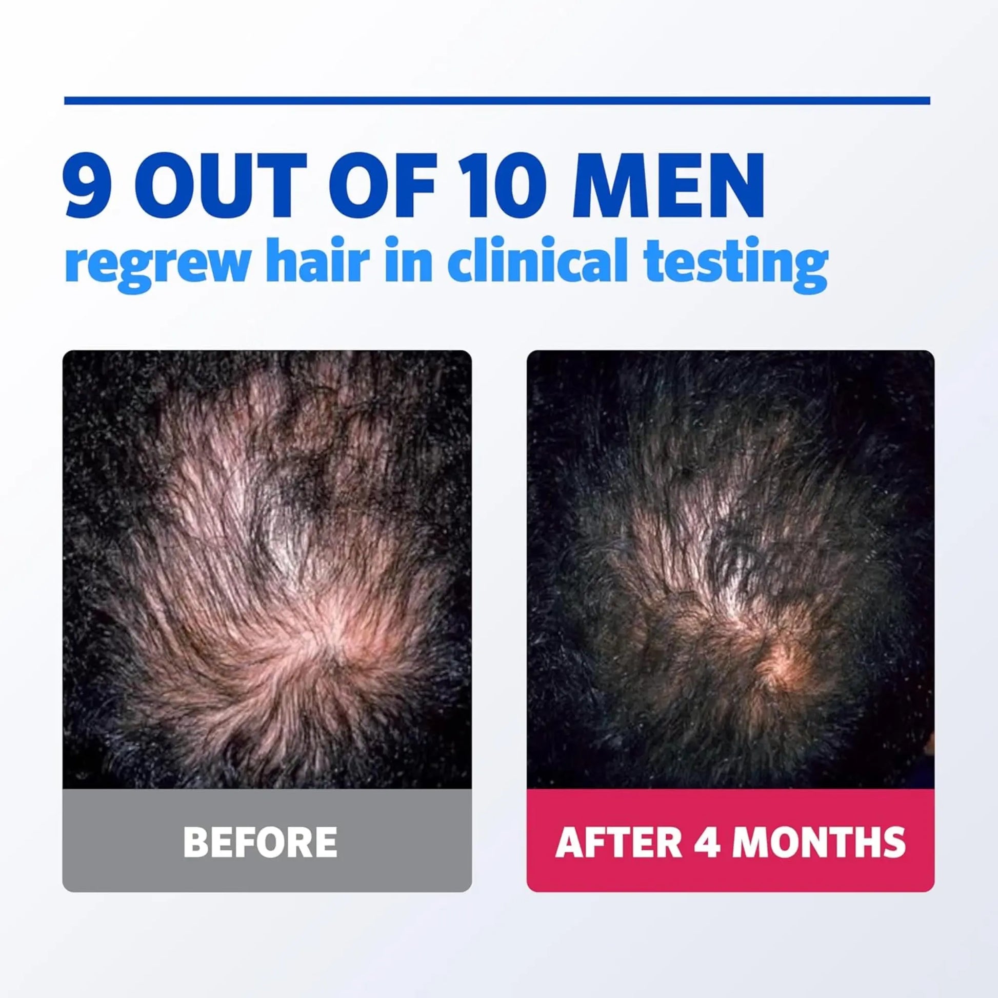 Before and after hair growth comparison with text '9 out of 10 men regrew hair in clinical testing'.