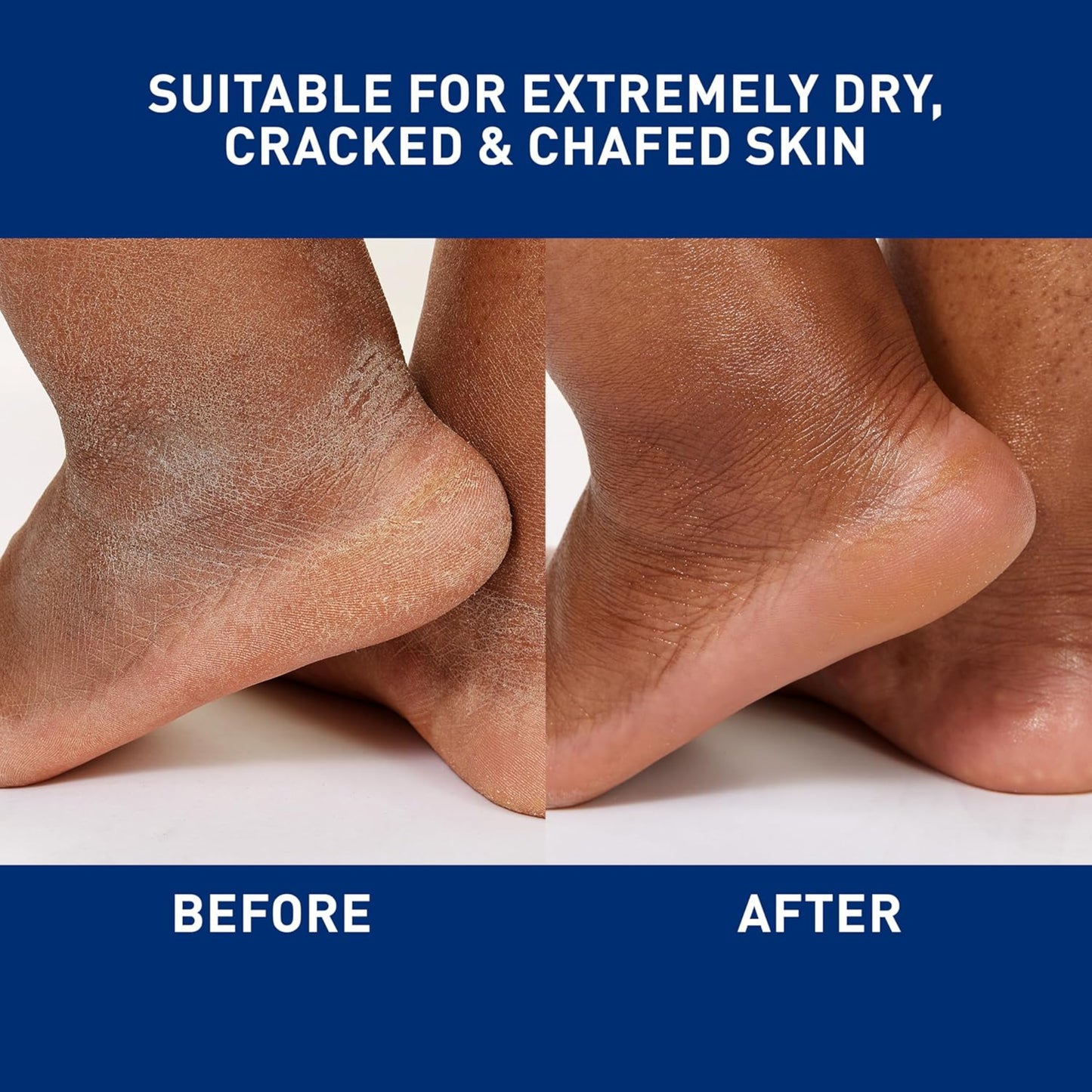 Before and after comparison of extremely dry, cracked, and chafed skin on feet.