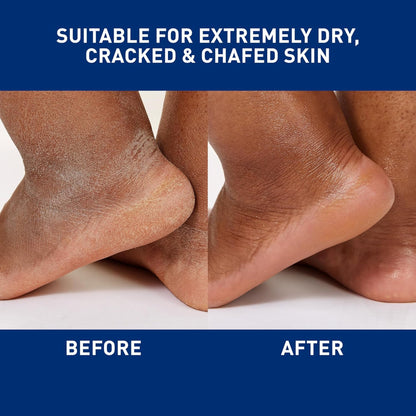 Before and after comparison of extremely dry, cracked, and chafed skin on feet.