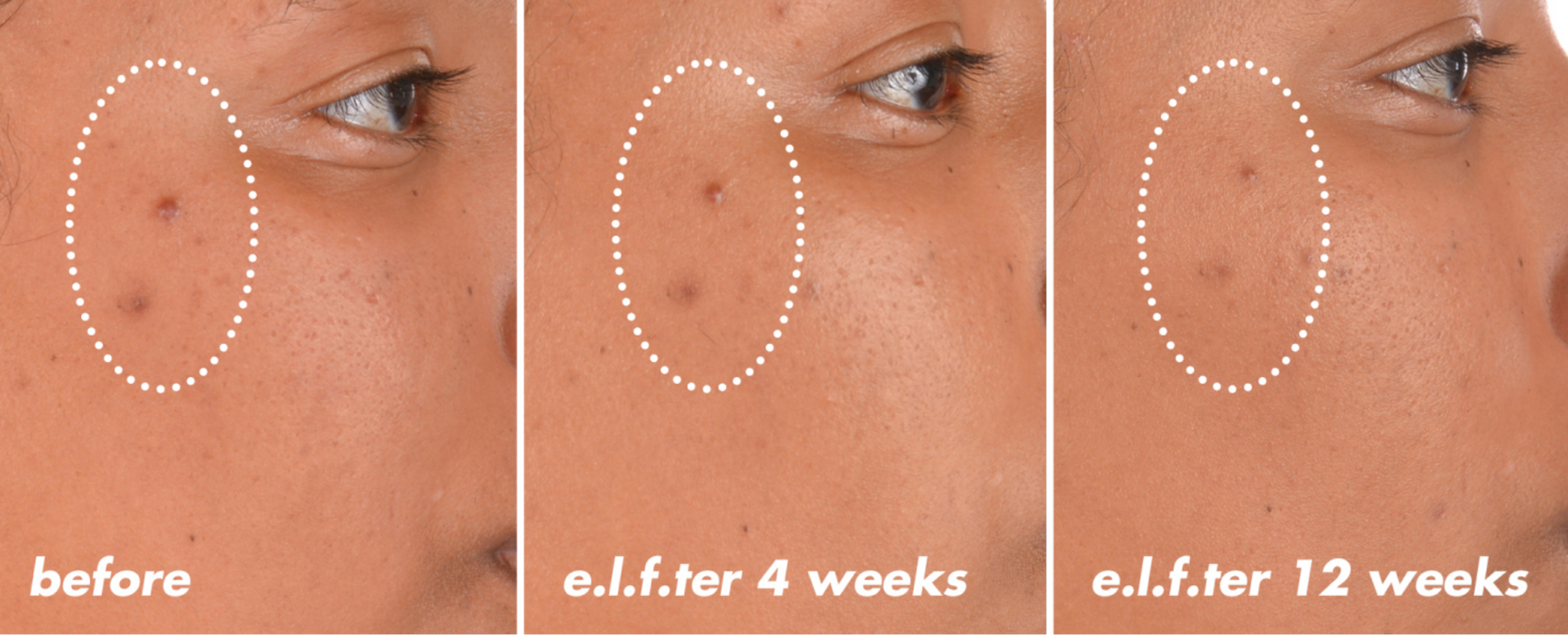 Before and after comparison of skin treatment with 'e.l.f.' branding, showing improvement over time.