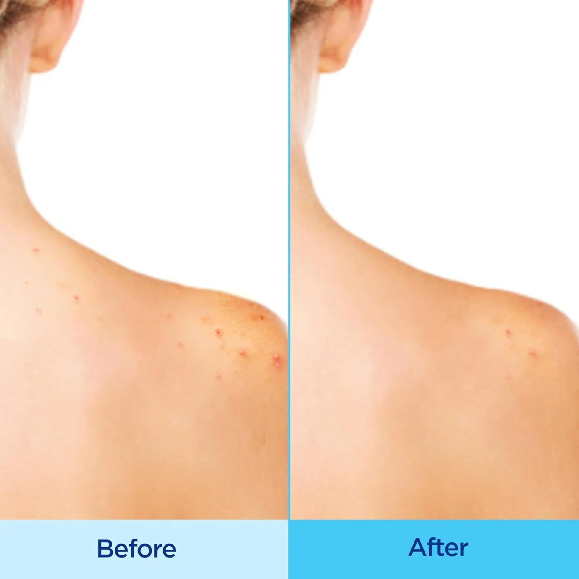 Differin - Acne Body Spray, Acne Treatment with Salicylic Acid - 170gr - Antiaging Cosmetics