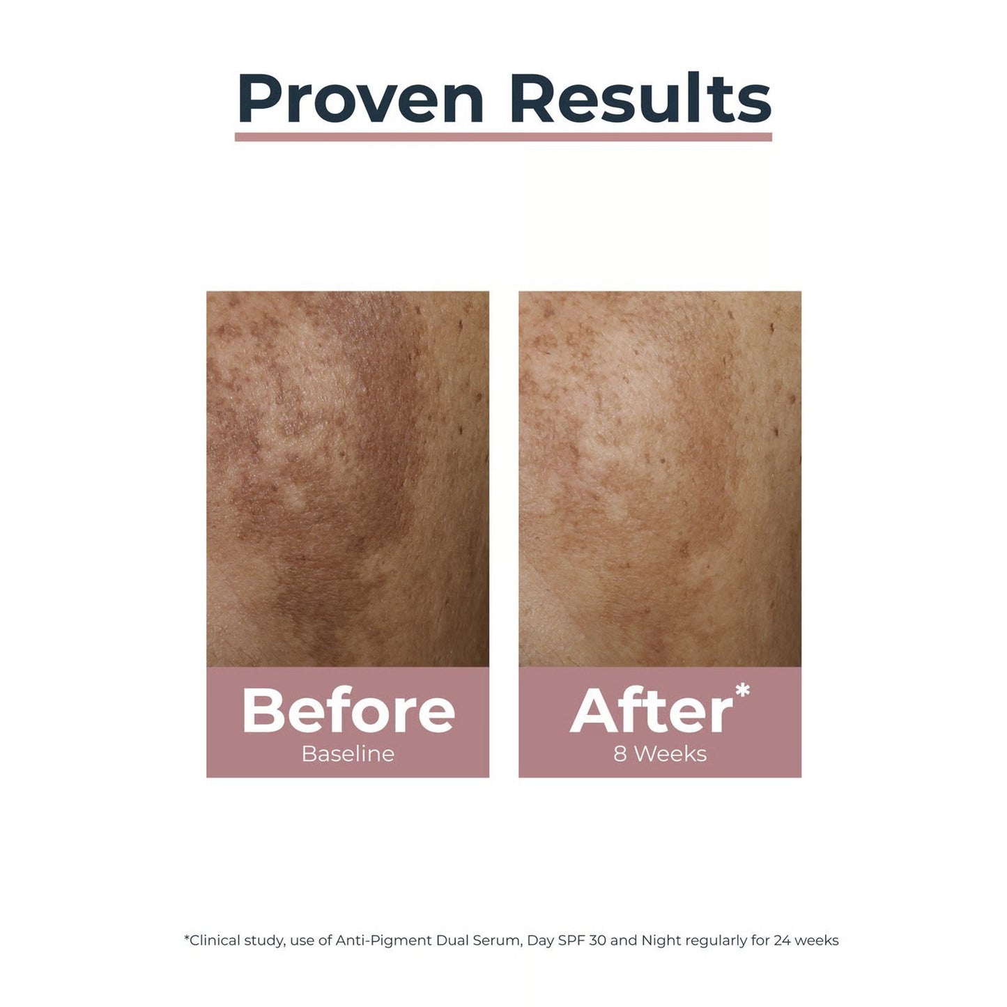 Eucerin Anti-Pigment ,Dual Serum Dark Spots 30ml (Europe version)