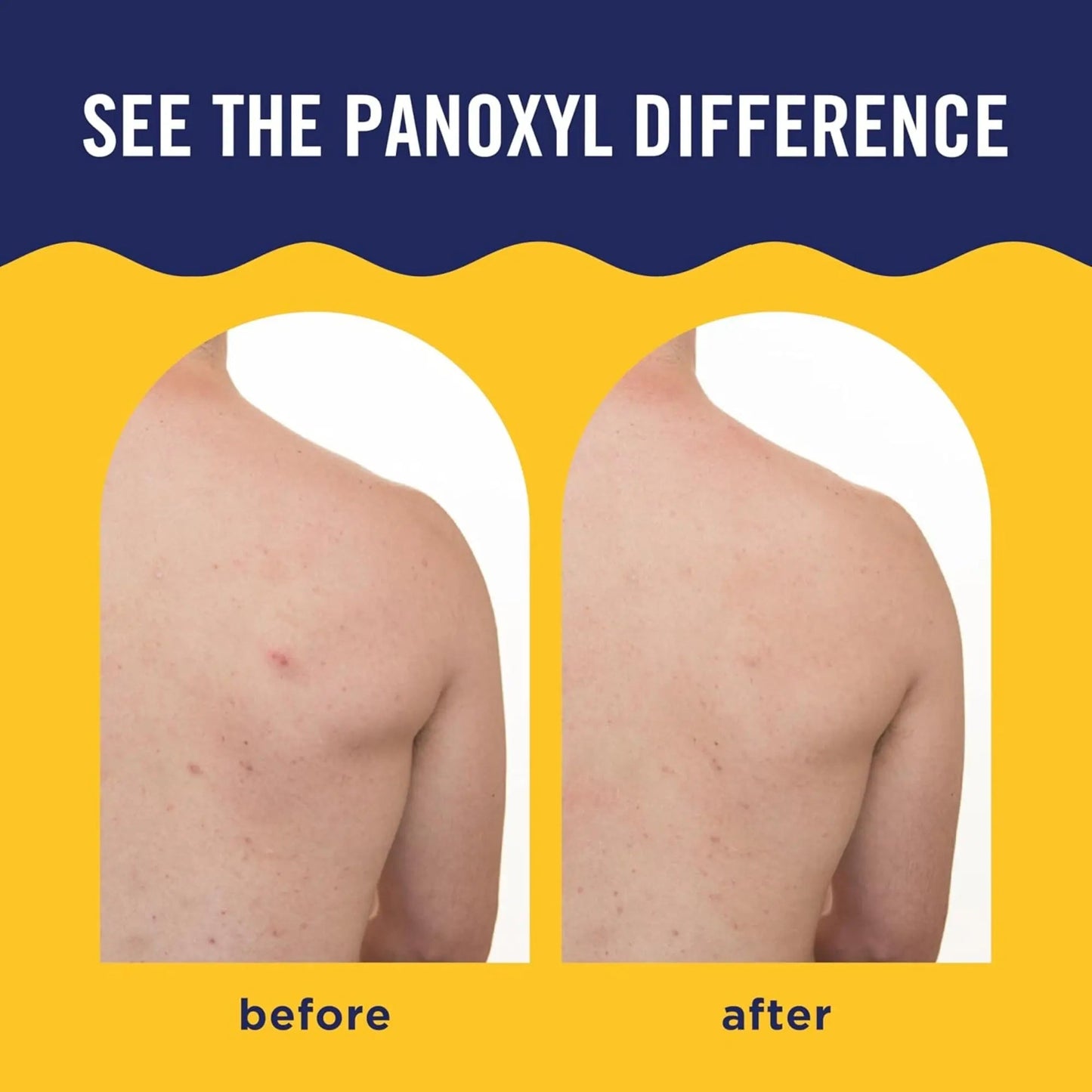 PanOxyl - Acne Banishing Body Spray Salicylic - 170gr - Antiaging Cosmetics