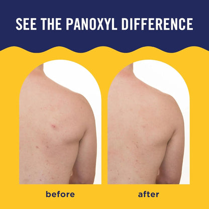 PanOxyl - Acne Banishing Body Spray Salicylic - 170gr - Antiaging Cosmetics