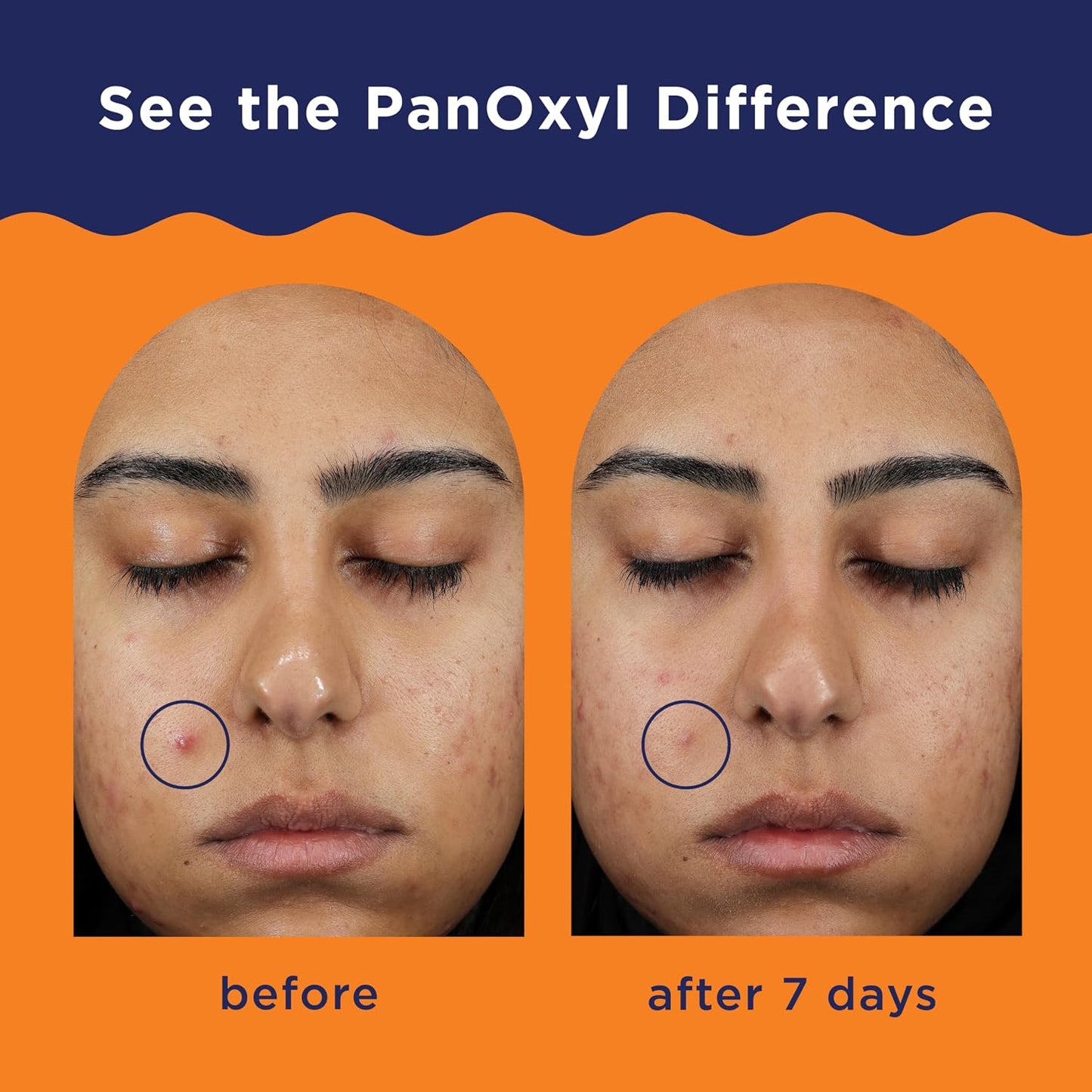 PanOxyl Acne Clearing Spot Treatment – 28gr - Antiaging Cosmetics